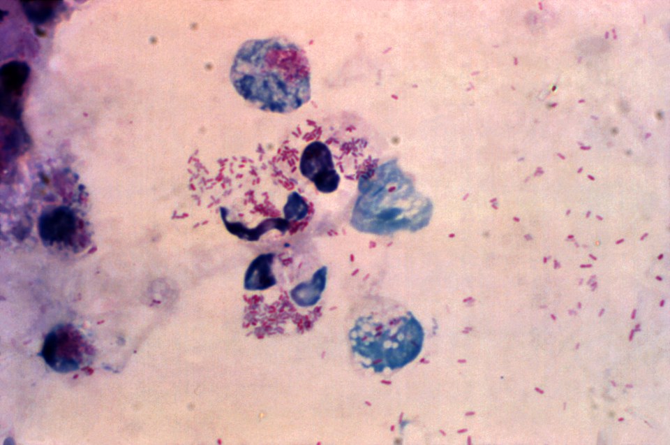 Figure 1: Microscopic image of fluid extracted from guinea pig infected with L. pneumophila stained with the Gimenez method. L. pneumophila cells are pink, host cells, such as macrophages are blue. Source: Public Health Image Library, Center for Disease Control, Dr. Joseph McDade (1978).