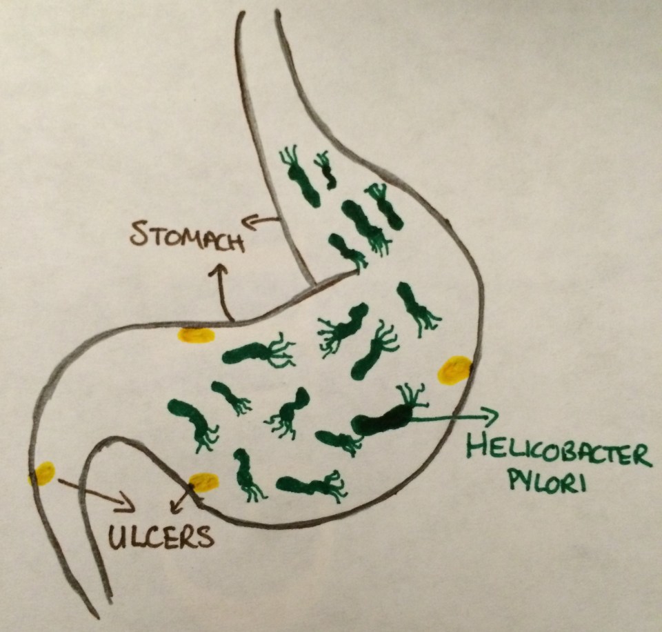 Figure 1: Ulcer formation caused by Helicobacter pylori infection in human stomach.