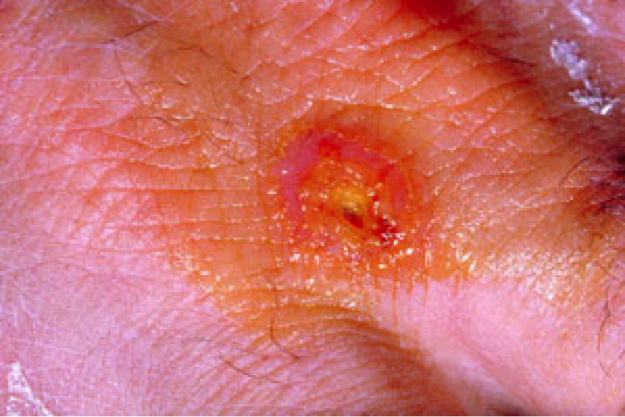 Figure 2: Ulcer formation at the site of infection by F. tularensis. Source: CDC Public Health Image Library (ID #2037). 