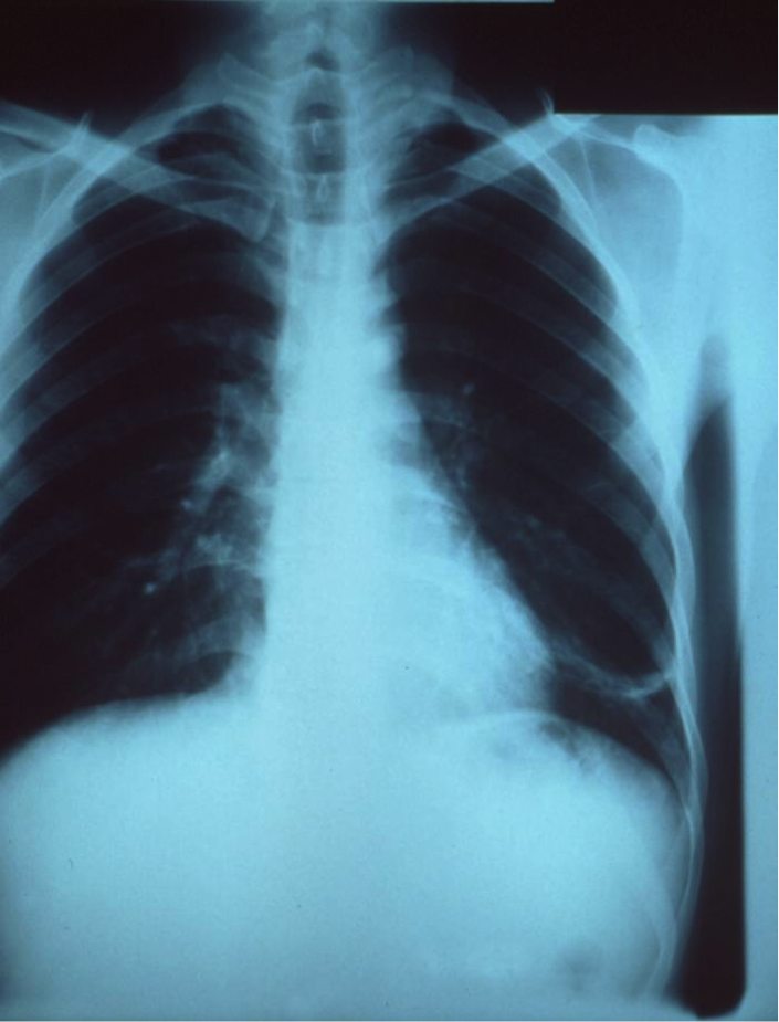 Figure 1 : X-ray of a patient's thorax revealing pneumoniae infection on the left lung lob. Source: http://phil.cdc.gov/phil/details.asp?pid=5800